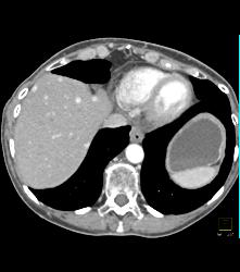 Recurrent Renal Cell Carcinoma With Adenopathy and Splenic Metastases - CTisus CT Scan