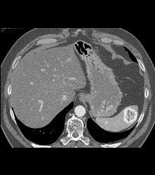 Recurrent Renal Cell Carcinoma With Adenopathy and Splenic Metastases - CTisus CT Scan