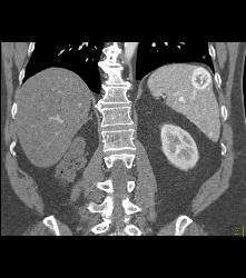 Recurrent Renal Cell Carcinoma With Adenopathy and Splenic Metastases - CTisus CT Scan