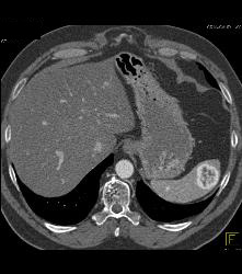 Recurrent Renal Cell Carcinoma With Adenopathy and Splenic Metastases - CTisus CT Scan