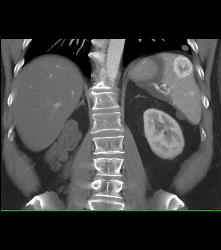 Recurrent Renal Cell Carcinoma With Adenopathy and Splenic Metastases - CTisus CT Scan