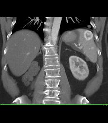 Recurrent Renal Cell Carcinoma With Adenopathy and Splenic Metastases - CTisus CT Scan