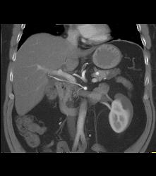 Recurrent Renal Cell Carcinoma With Adenopathy and Splenic Metastases - CTisus CT Scan