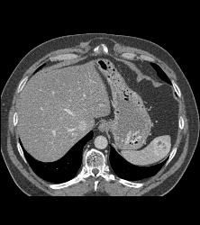 Recurrent Renal Cell Carcinoma With Adenopathy and Splenic Metastases - CTisus CT Scan