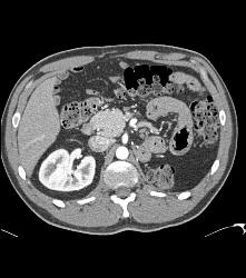 Normal Left Nephrectomy Bed - CTisus CT Scan