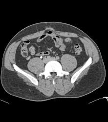 Normal Left Nephrectomy Bed - CTisus CT Scan