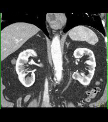 1 Cm Renal Cell Carcinoma Medial Aspect of Left Kidney See Sequence - CTisus CT Scan