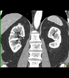 1 Cm Renal Cell Carcinoma Medial Aspect of Left Kidney See Sequence - CTisus CT Scan