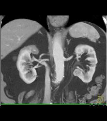 1 Cm Renal Cell Carcinoma Medial Aspect of Left Kidney See Sequence - CTisus CT Scan