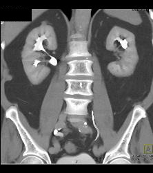 1 Cm Renal Cell Carcinoma Medial Aspect of Left Kidney See Sequence - CTisus CT Scan