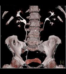 1 Cm Renal Cell Carcinoma Medial Aspect of Left Kidney See Sequence - CTisus CT Scan