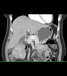 Post Left Nephrectomy - CTisus CT Scan