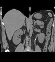 Stone in Left Ureter -see Full Sequence for All Phases - CTisus CT Scan