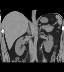 Stone in Left Ureter -see Full Sequence for All Phases - CTisus CT Scan