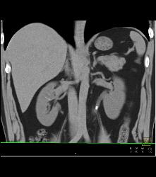 Stone in Left Ureter -see Full Sequence for All Phases - CTisus CT Scan