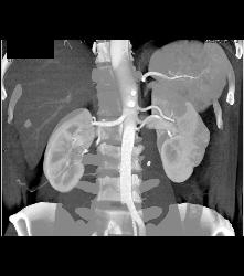 Stone in Left Ureter -see Full Sequence for All Phases - CTisus CT Scan