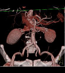 Stone in Left Ureter -see Full Sequence for All Phases - CTisus CT Scan