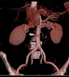 Stone in Left Ureter -see Full Sequence for All Phases - CTisus CT Scan