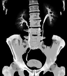 Stone in Left Ureter -see Full Sequence for All Phases - CTisus CT Scan