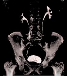 Stone in Left Ureter -see Full Sequence for All Phases - CTisus CT Scan