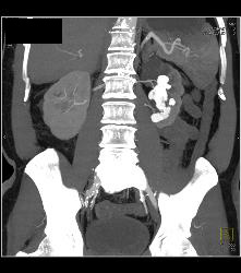 Staghorn Calculus Left Kidney - Kidney Case Studies - CTisus CT Scanning