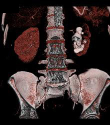 Staghorn Calculus Left Kidney - CTisus CT Scan