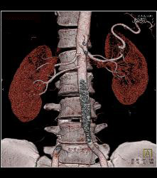 Renal Donor With Multiple Renal Arteries - CTisus CT Scan