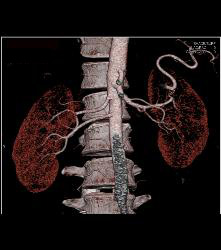 Renal Donor With Multiple Renal Arteries - CTisus CT Scan