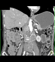 Recurrent Renal Cell Carcinoma With Vascular Liver Metastases - CTisus CT Scan