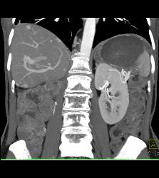 Recurrent Renal Cell Carcinoma With Vascular Liver Metastases - CTisus CT Scan