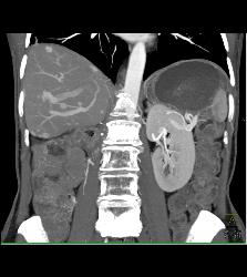 Recurrent Renal Cell Carcinoma With Vascular Liver Metastases - CTisus CT Scan