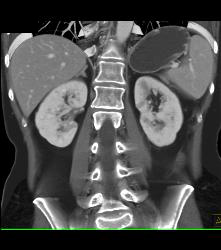 Small Renal Cysts - CTisus CT Scan