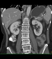 Small Renal Cysts - CTisus CT Scan