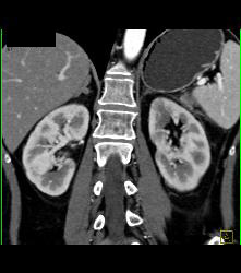 Small Renal Cysts - CTisus CT Scan