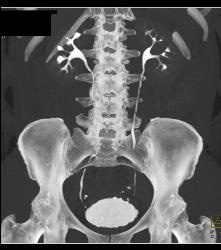 Small Renal Cysts - CTisus CT Scan