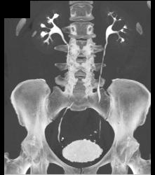 Small Renal Cysts - CTisus CT Scan