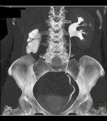 Right Ureteropelvic Junction (UPJ) - CTisus CT Scan