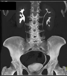 Duplicated Left Collecting System - CTisus CT Scan