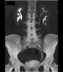 Duplicated Left Collecting System - CTisus CT Scan