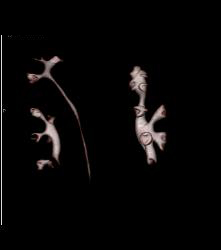 Duplicated Left Collecting System - CTisus CT Scan