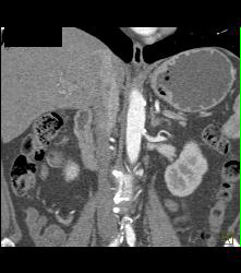 Stenosis of the Left Renal Artery - CTisus CT Scan