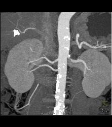 Stenosis of the Left Renal Artery - CTisus CT Scan