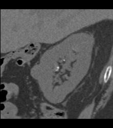 Left Nephrectomy With 1cm Tumor Right Kidney -see Sequence. Liver Lesion Was A Hemangioma. - CTisus CT Scan