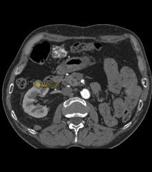 Left Nephrectomy With 1cm Tumor Right Kidney -see Sequence. Liver Lesion Was A Hemangioma. - CTisus CT Scan