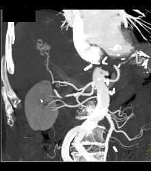 Left Nephrectomy With 1cm Tumor Right Kidney -see Sequence. Liver Lesion Was A Hemangioma. - CTisus CT Scan