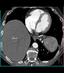 Left Nephrectomy With 1cm Tumor Right Kidney -see Sequence. Liver Lesion Was A Hemangioma. - CTisus CT Scan