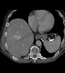 Left Nephrectomy With 1cm Tumor Right Kidney -see Sequence. Liver Lesion Was A Hemangioma - CTisus CT Scan