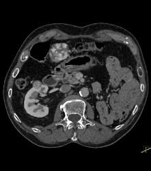 Left Nephrectomy With 1cm Tumor Right Kidney -see Sequence. Liver Lesion Was A Hemangioma. - CTisus CT Scan