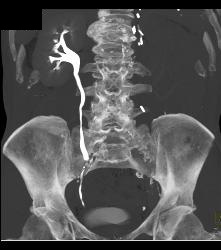 Left Nephrectomy With 1cm Tumor Right Kidney -see Sequence. Liver Lesion Was A Hemangioma. - CTisus CT Scan