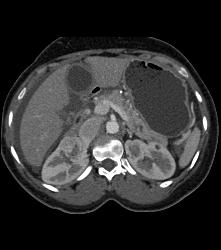 Bilateral Renal Cell Carcinoma - CTisus CT Scan